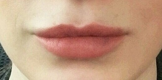 juvederm AFTER 1
