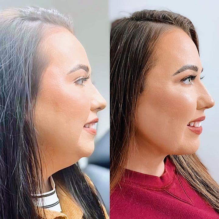 chin liposuction before and after