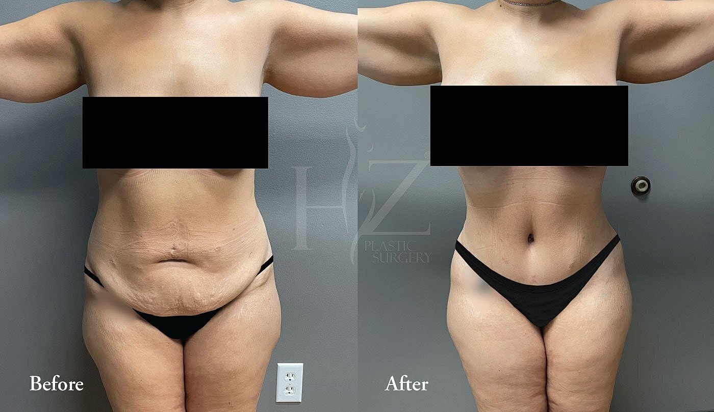 Before and after plastic surgery transformation.