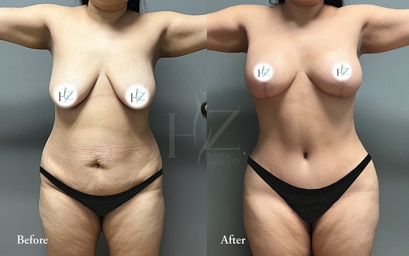Before and after plastic surgery comparison photo.