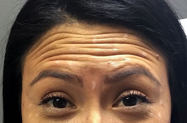Close-up of forehead with visible wrinkles.