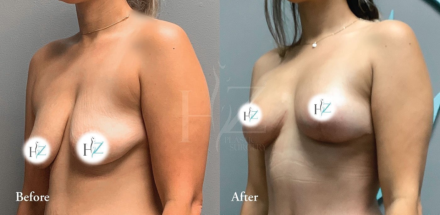 Breast augmentation before and after comparison image.
