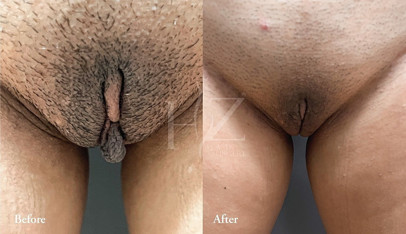 Before and after comparison of surgical results.