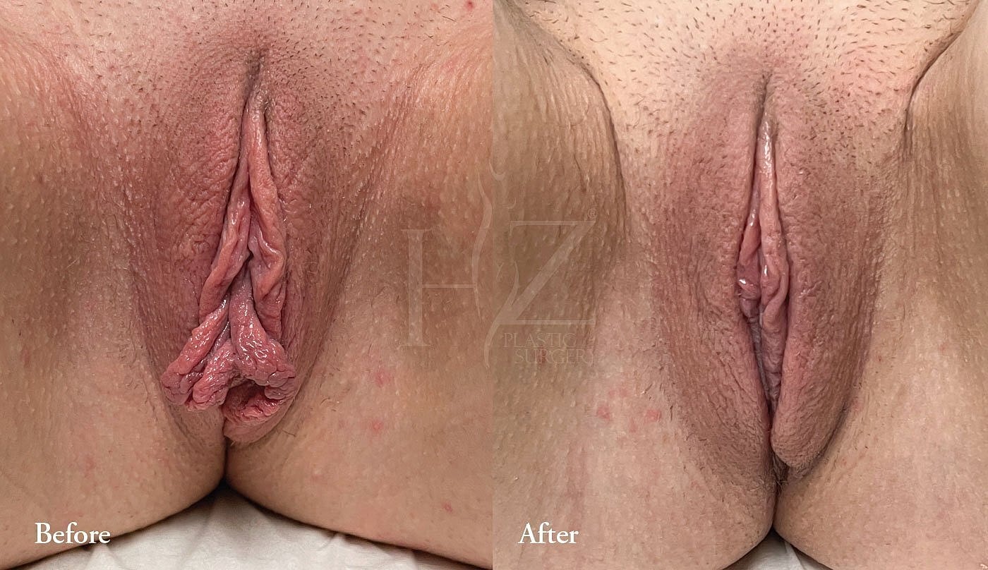 Before and after cosmetic procedure comparison.