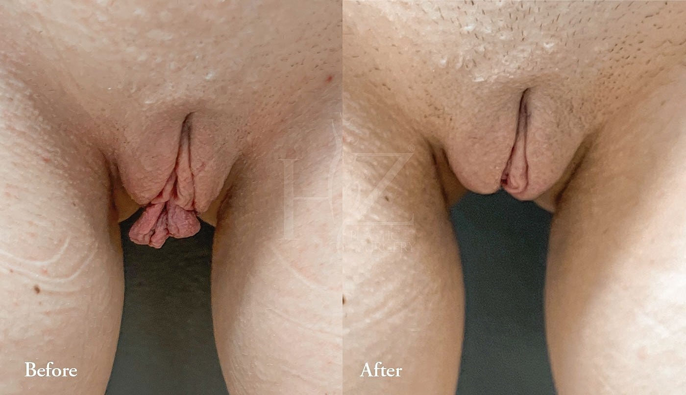 Before and after cosmetic surgery comparison image.