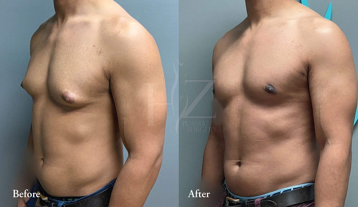 Male chest transformation before and after surgery.