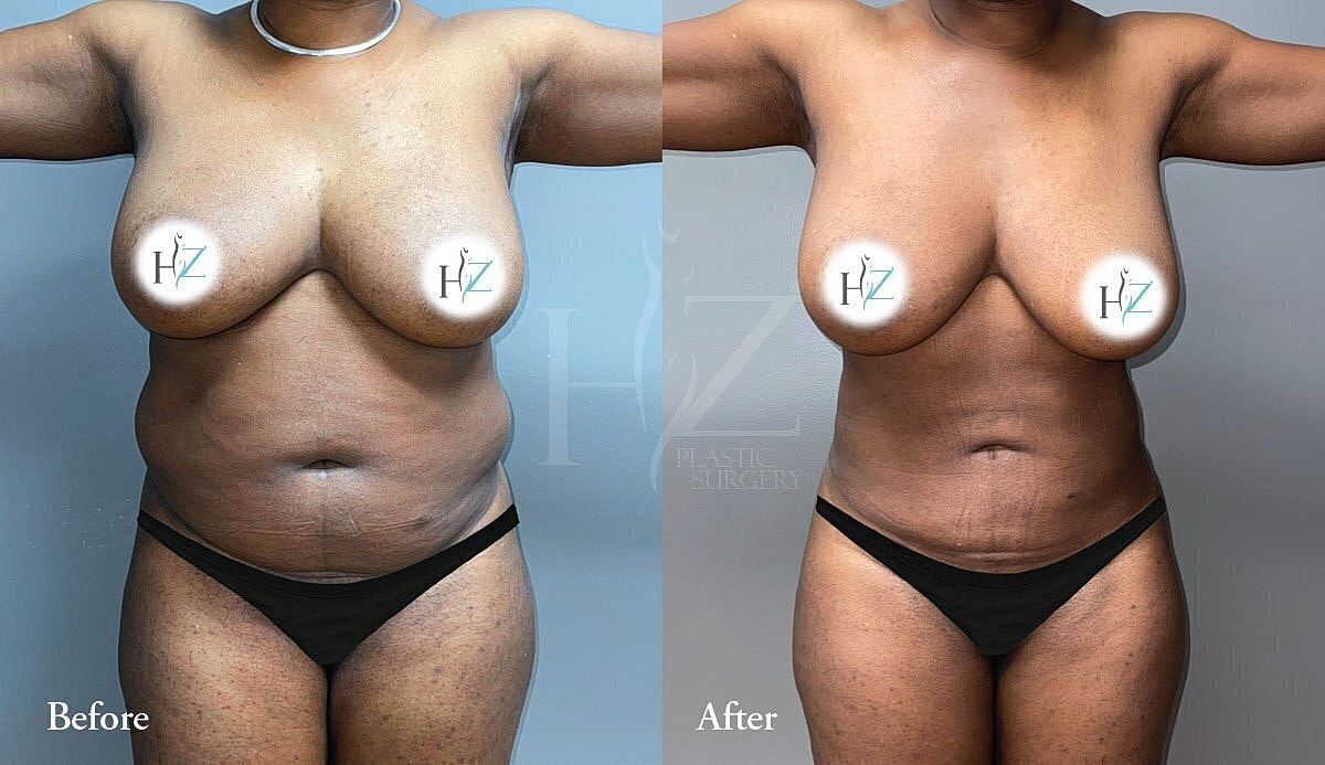 Before and after plastic surgery transformation.