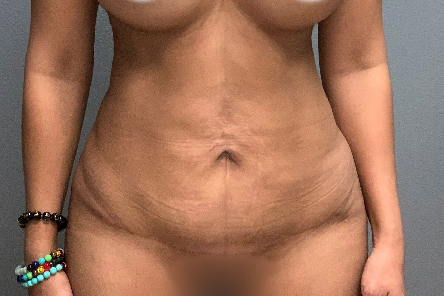 Close-up of a torso showing skin texture.