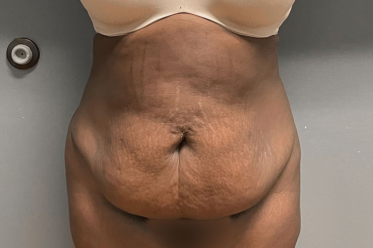 Close-up of a stomach area with stretch marks.