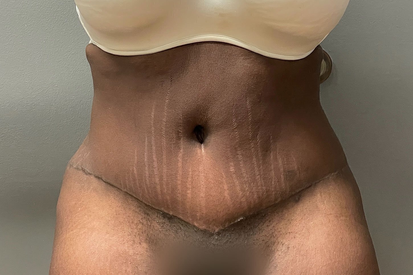 Belly with stretch marks and skin details.