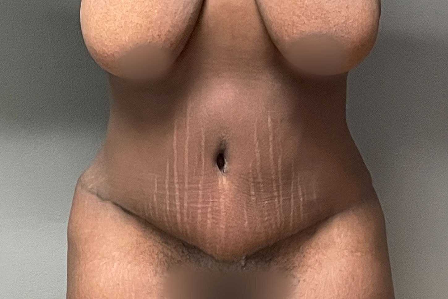 Close-up of abdomen showcasing skin textures.