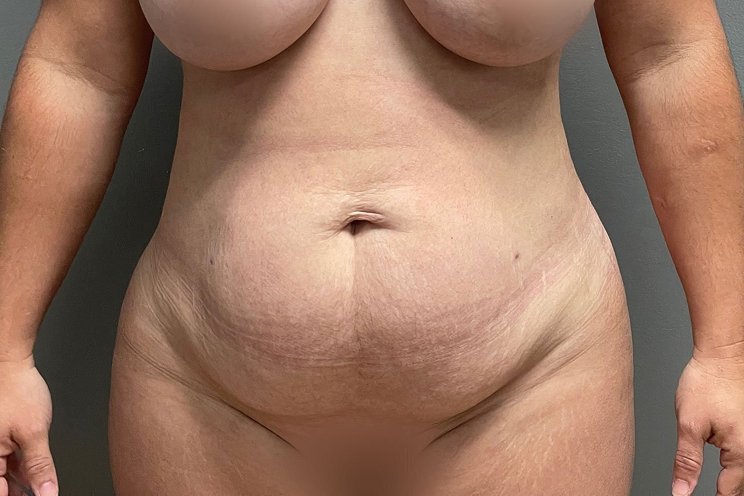 Body image showing stomach and stretch marks.
