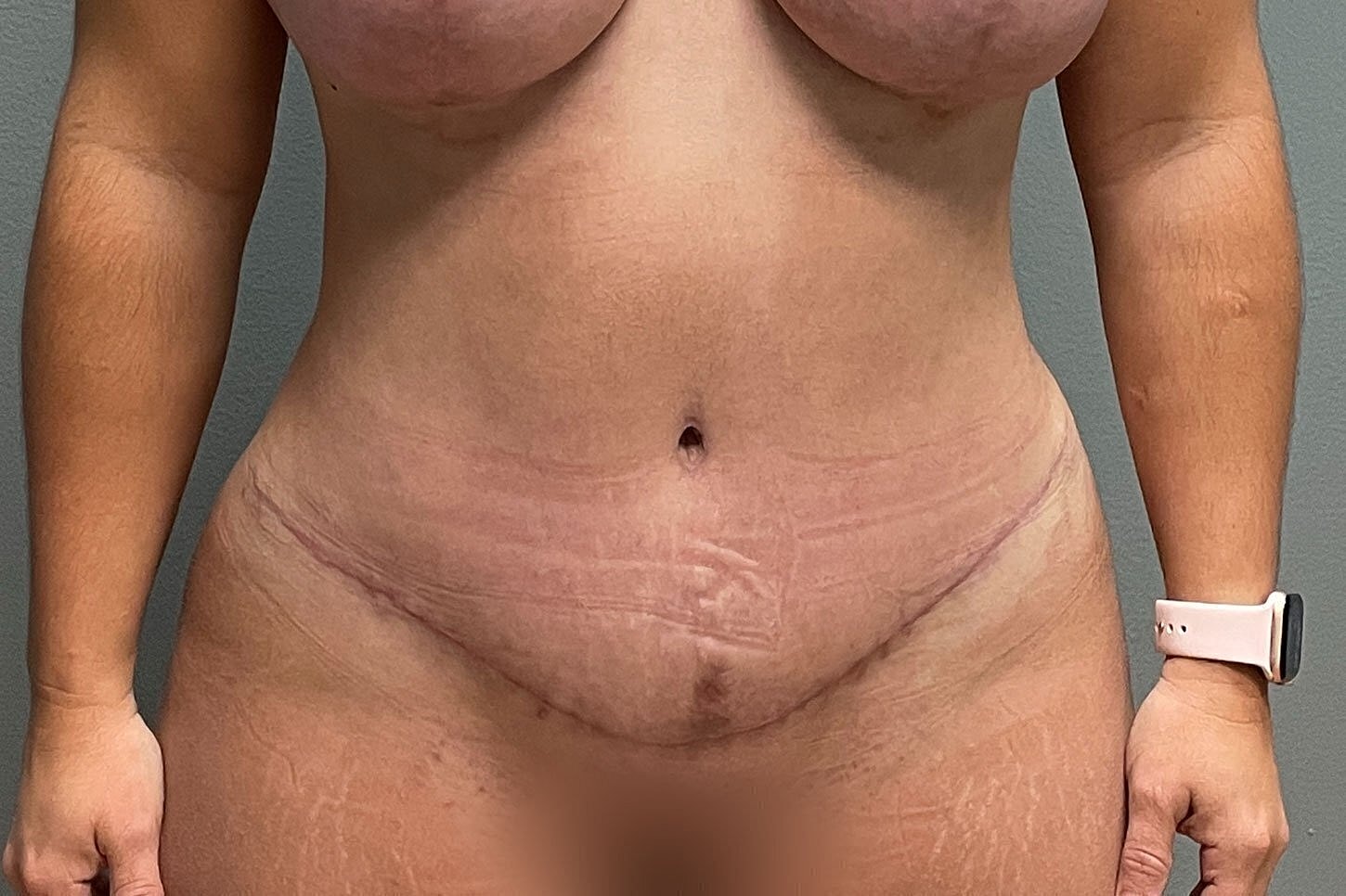 Body with visible skin texture and marks.