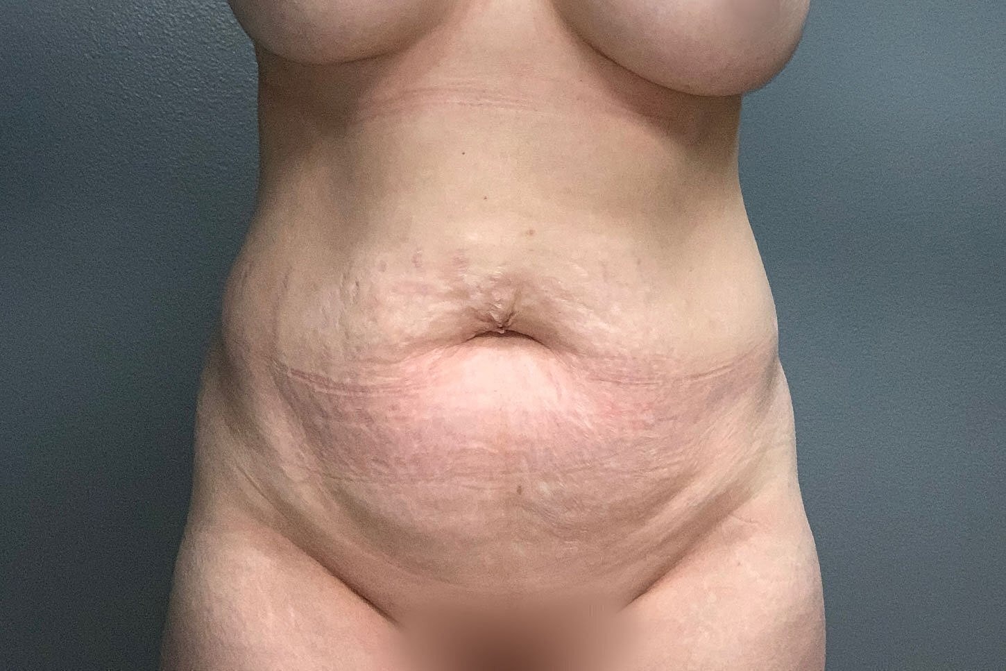 Woman's abdomen with visible skin texture and stretch marks.