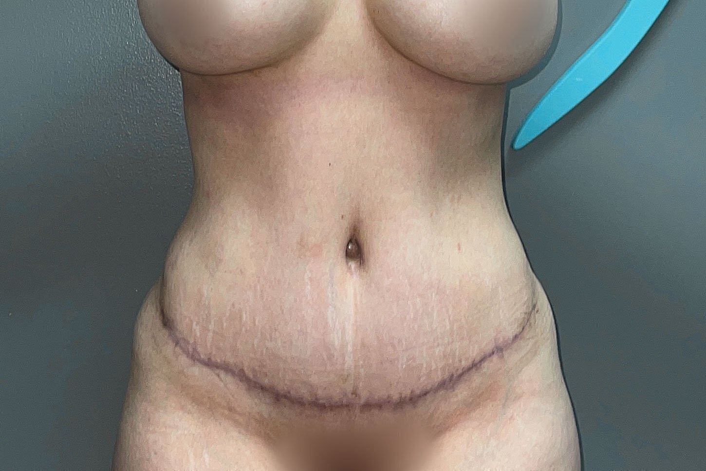 Post-surgery abdominal view with visible scar.