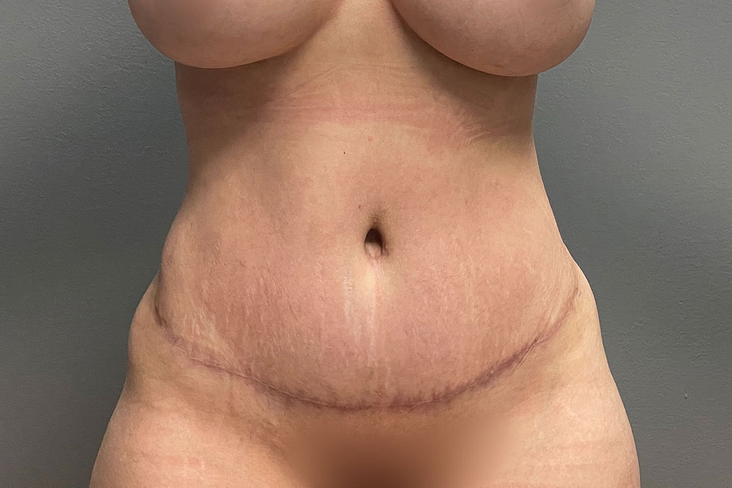 Post-surgery belly with visible scarring and stretch marks.