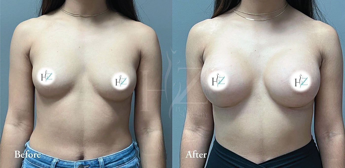 Before and after breast augmentation comparison image.