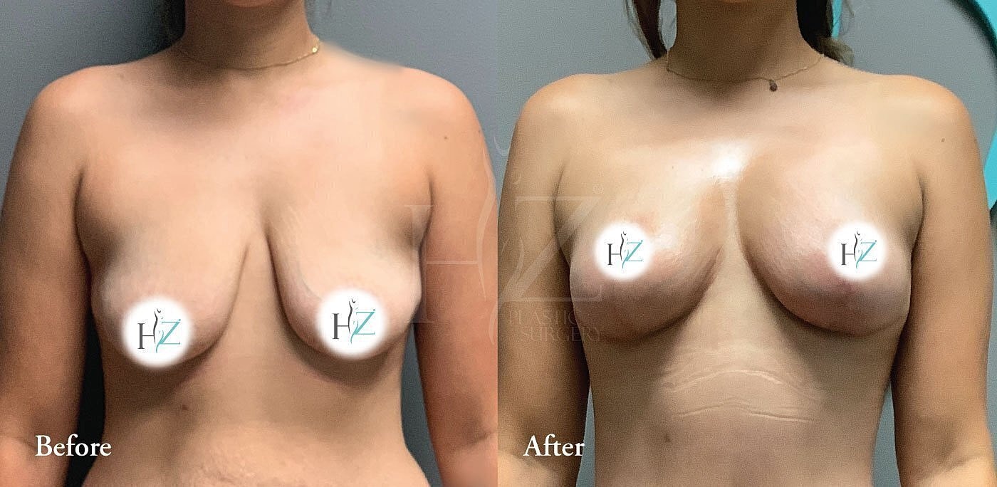 Before and after breast augmentation comparison image.