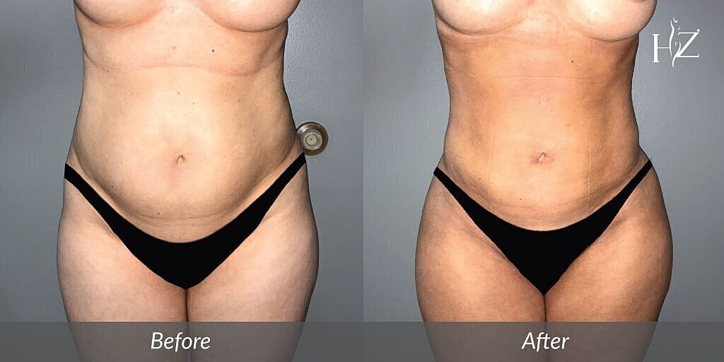 Body transformation before and after comparison.