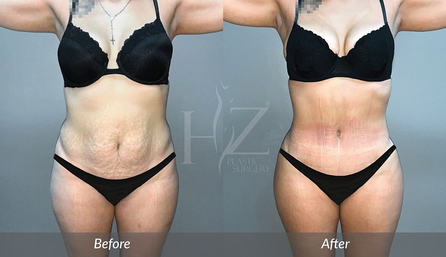 Before and after body contouring results.