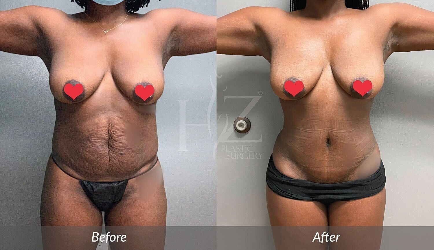 Plastic surgery before and after transformation image.