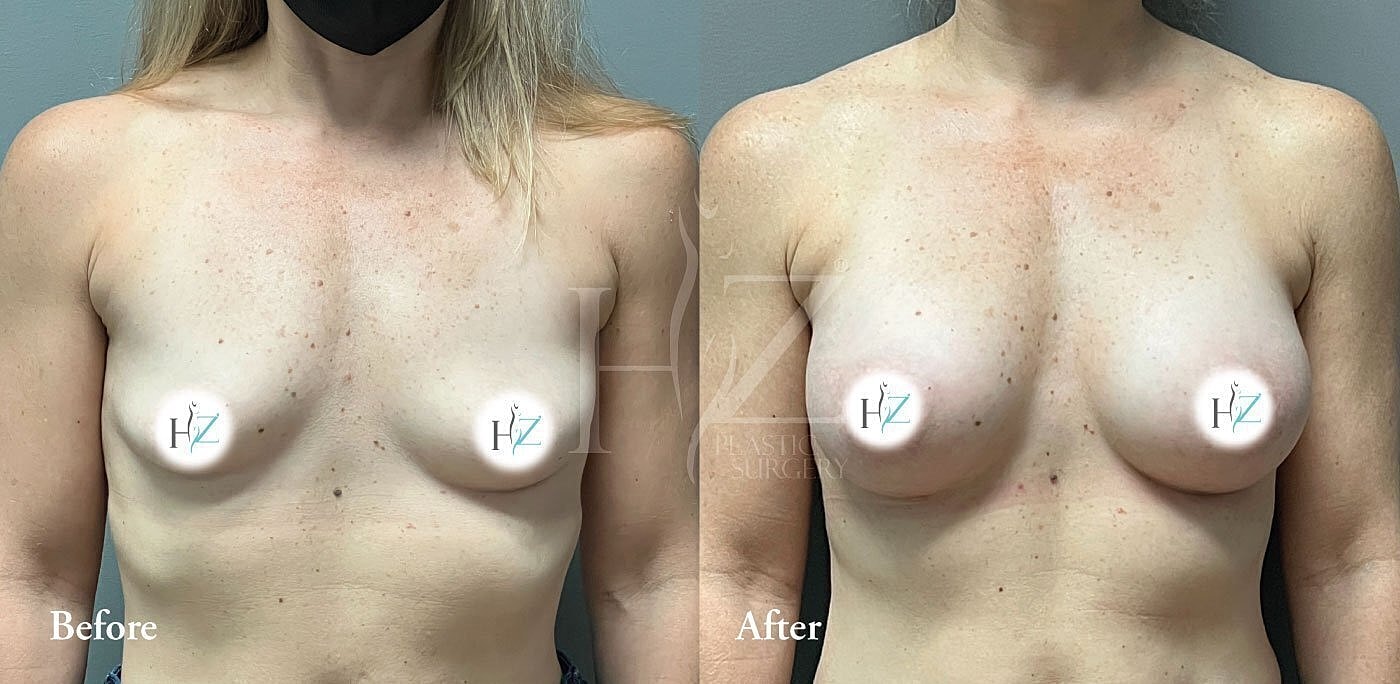 Before and after breast augmentation comparison image.