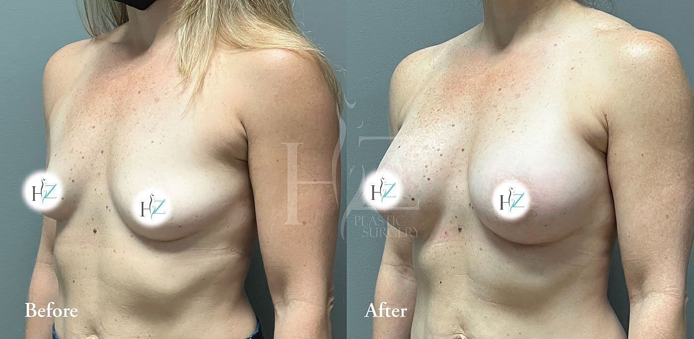 Breast enhancement before and after comparison image.