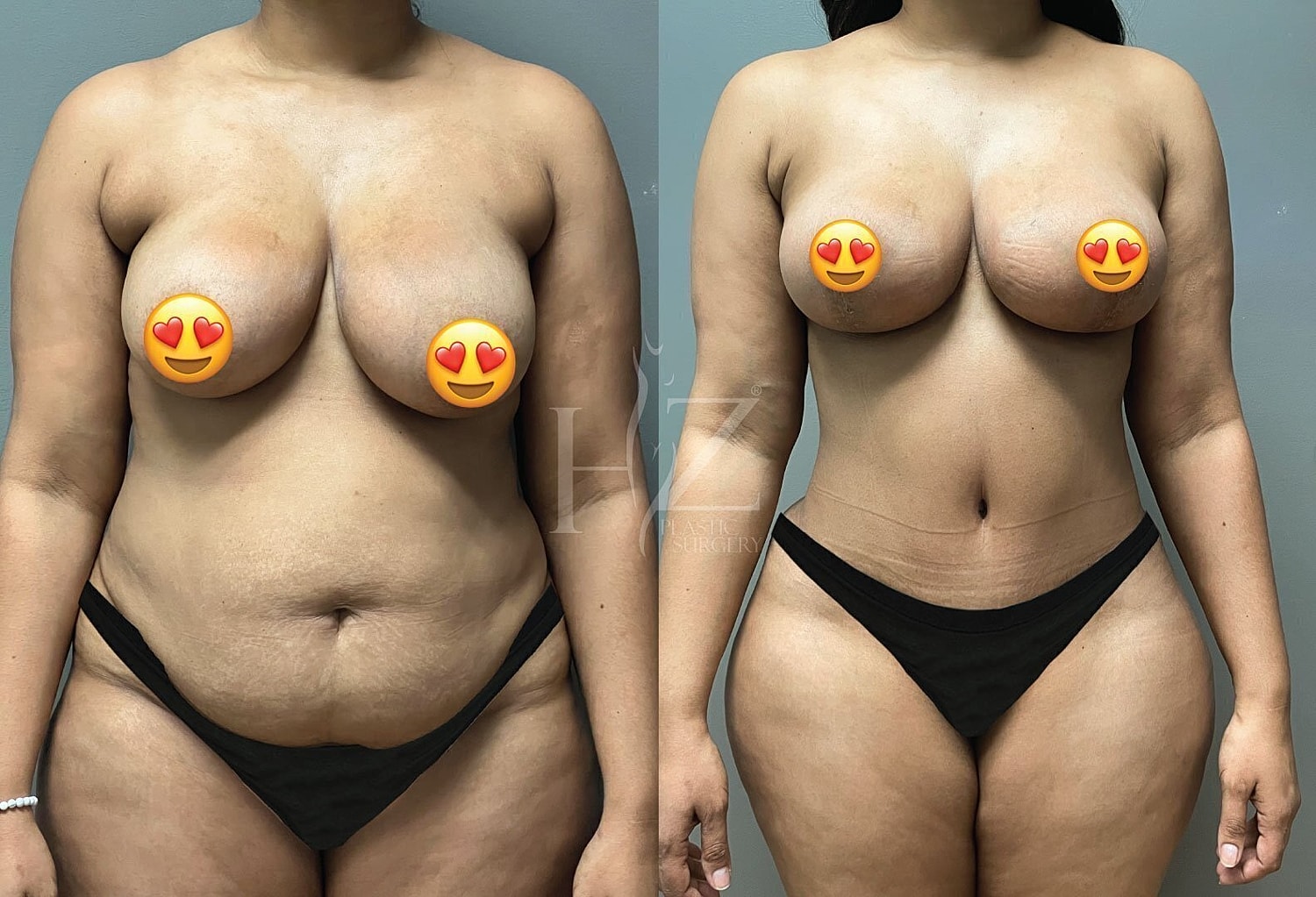Before and after body transformation photo.