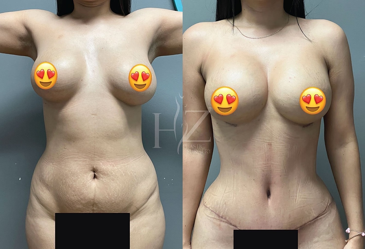 Before and after body transformation comparison.