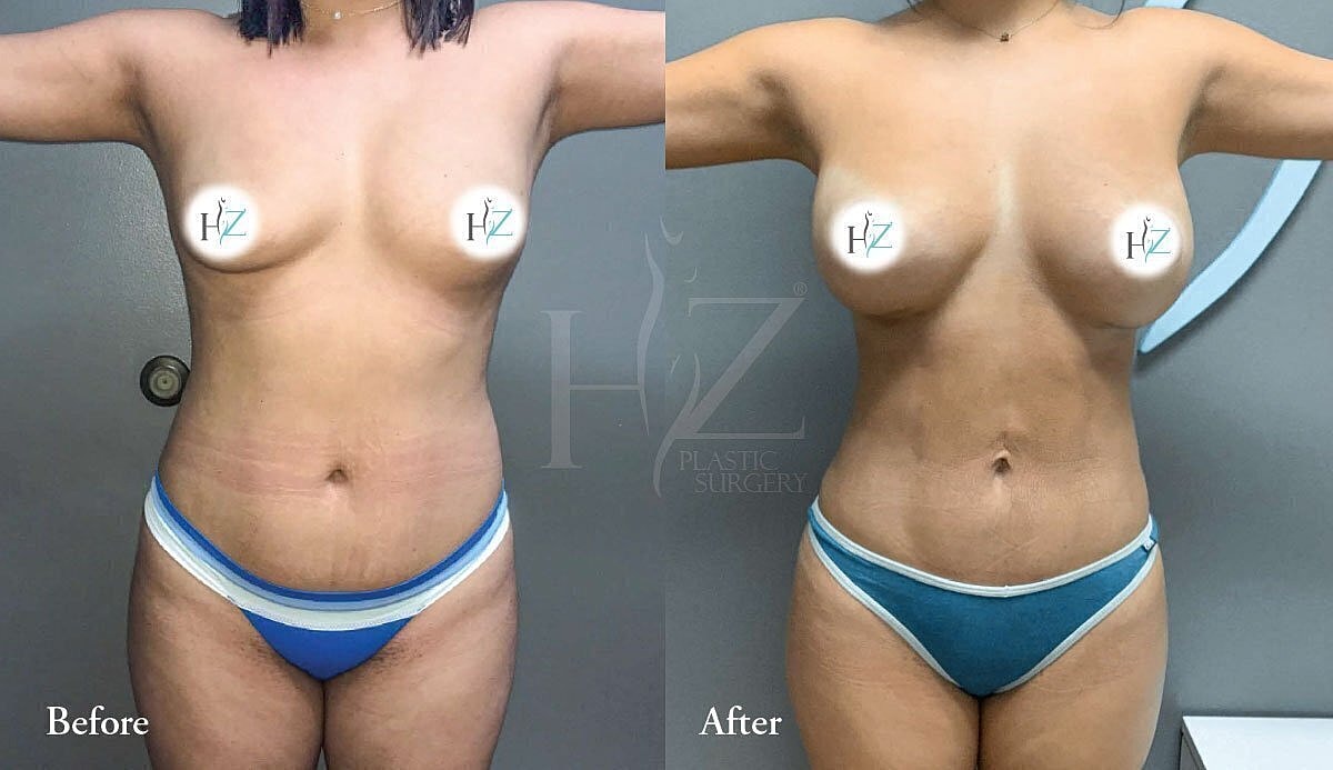Before and after breast augmentation comparison photo.