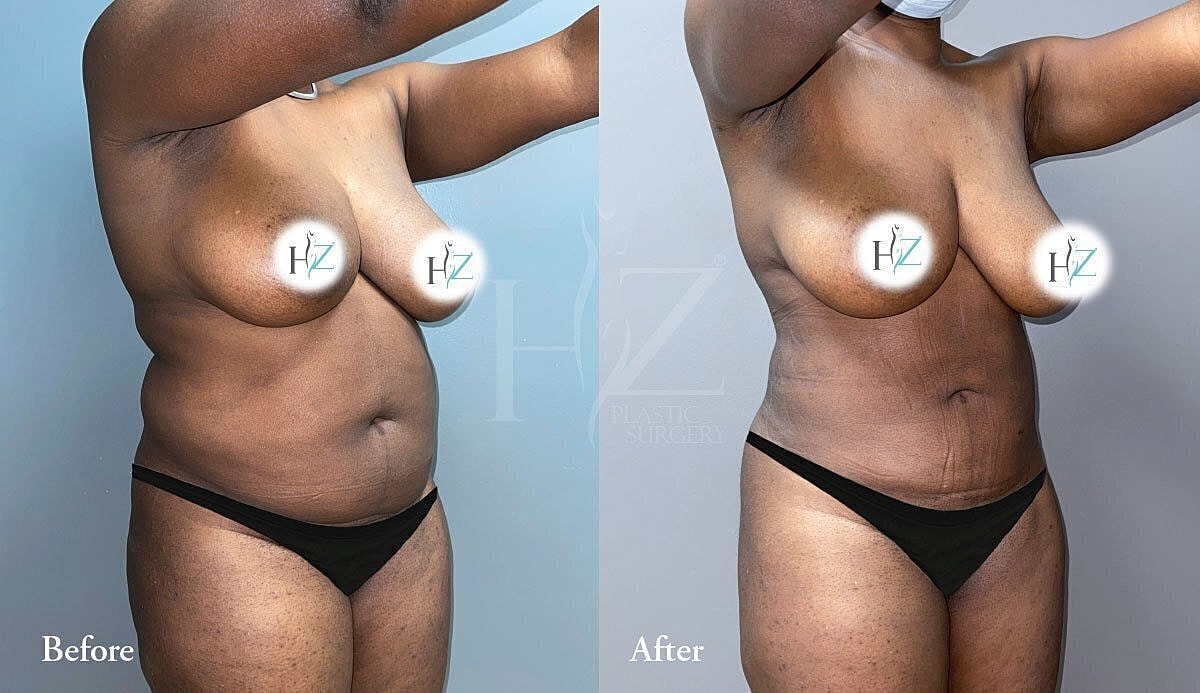 Before and after body contouring transformation.