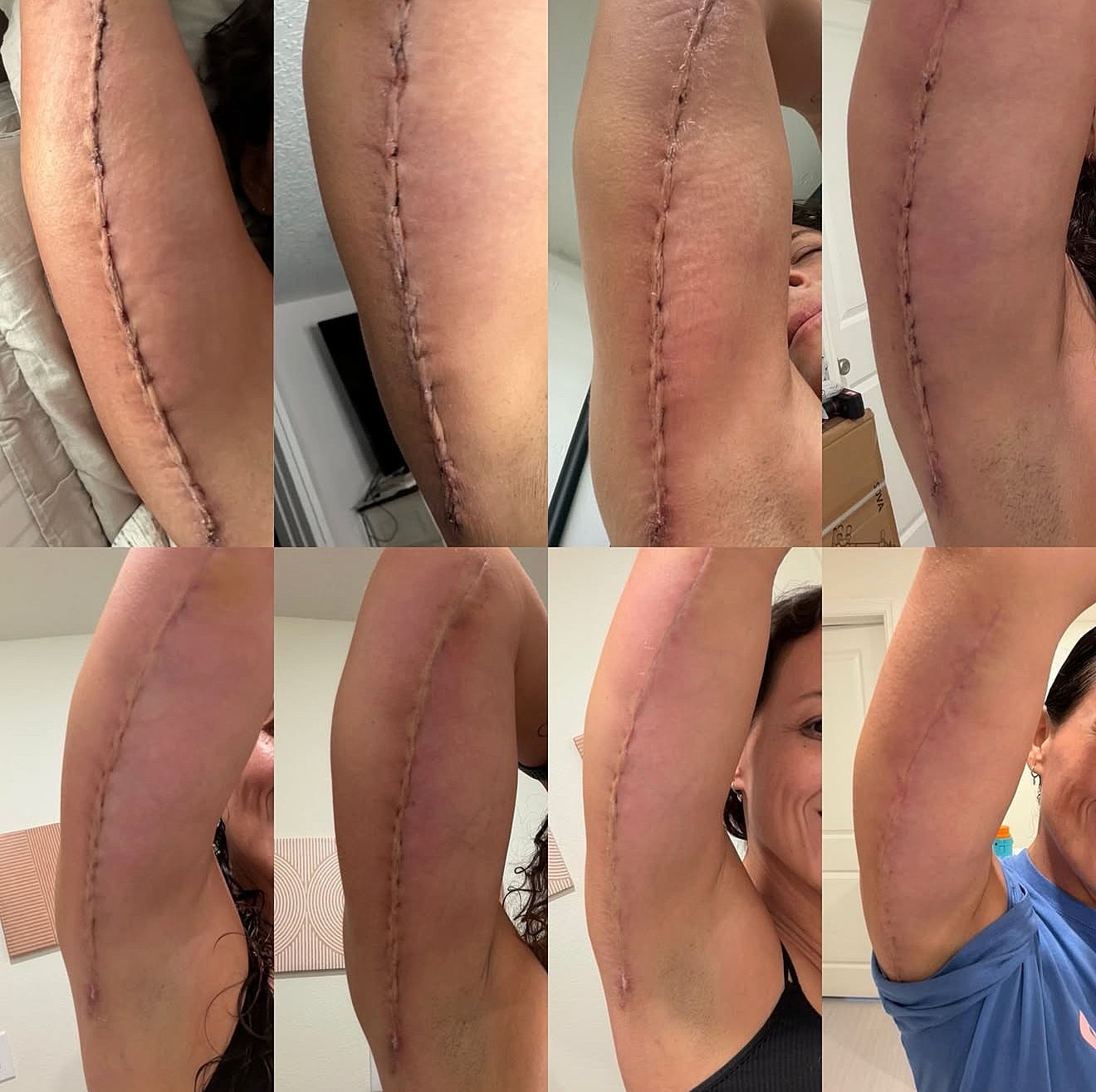 arm lift before and after orlando fl