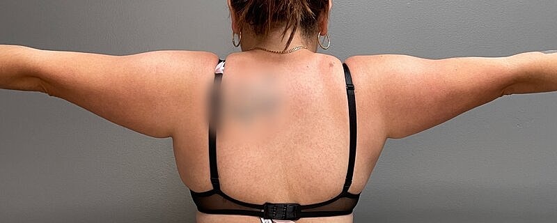 Liposuction Arms Before & After