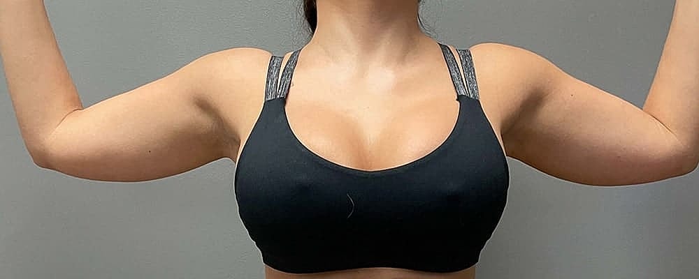 Liposuction Arms Before & After