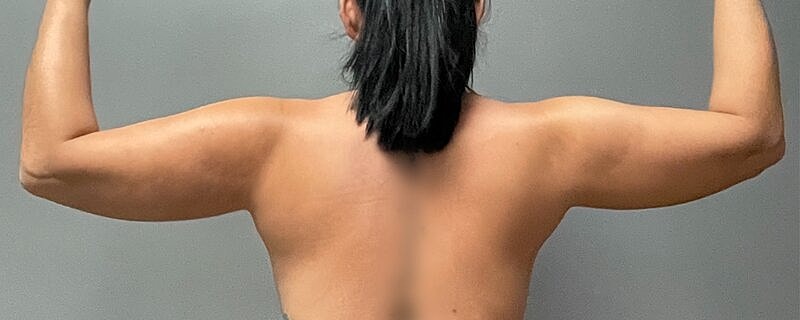 Liposuction Arms Before & After
