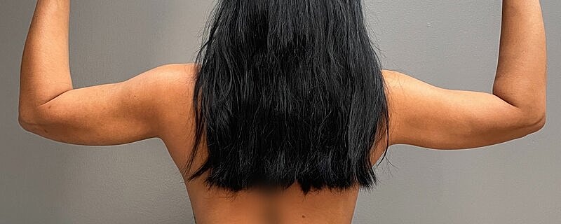 Liposuction Arms Before & After