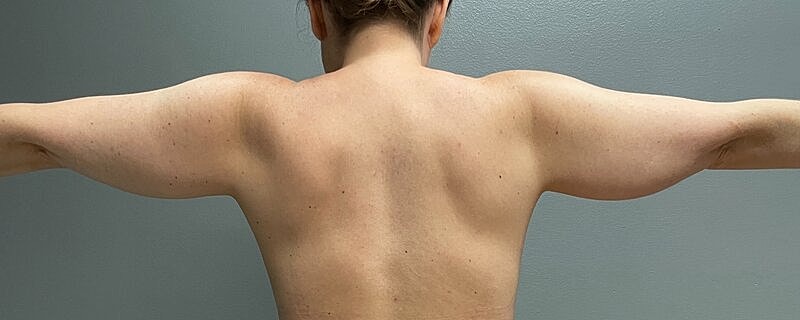 Liposuction Arms Before & After