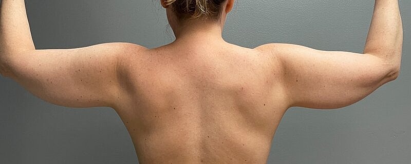 Liposuction Arms Before & After