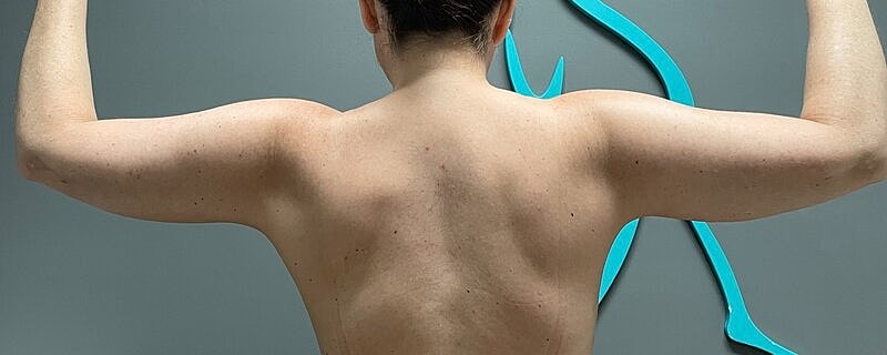 Liposuction Arms Before & After