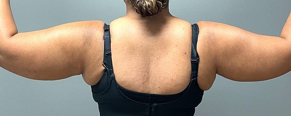 Liposuction Arms Before & After