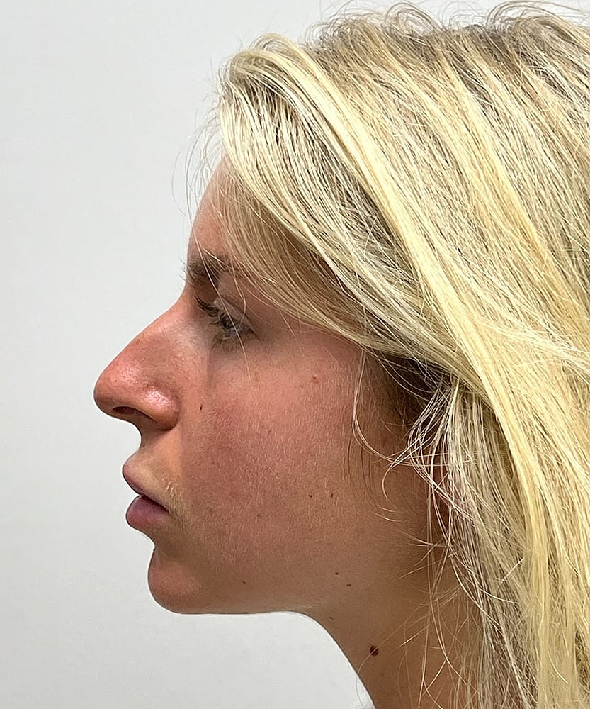 Rhinoplasty Before & After