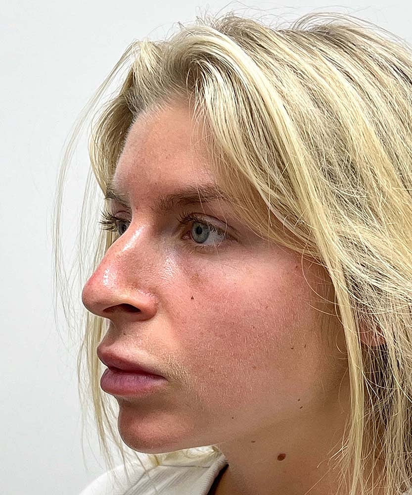 Rhinoplasty Before & After