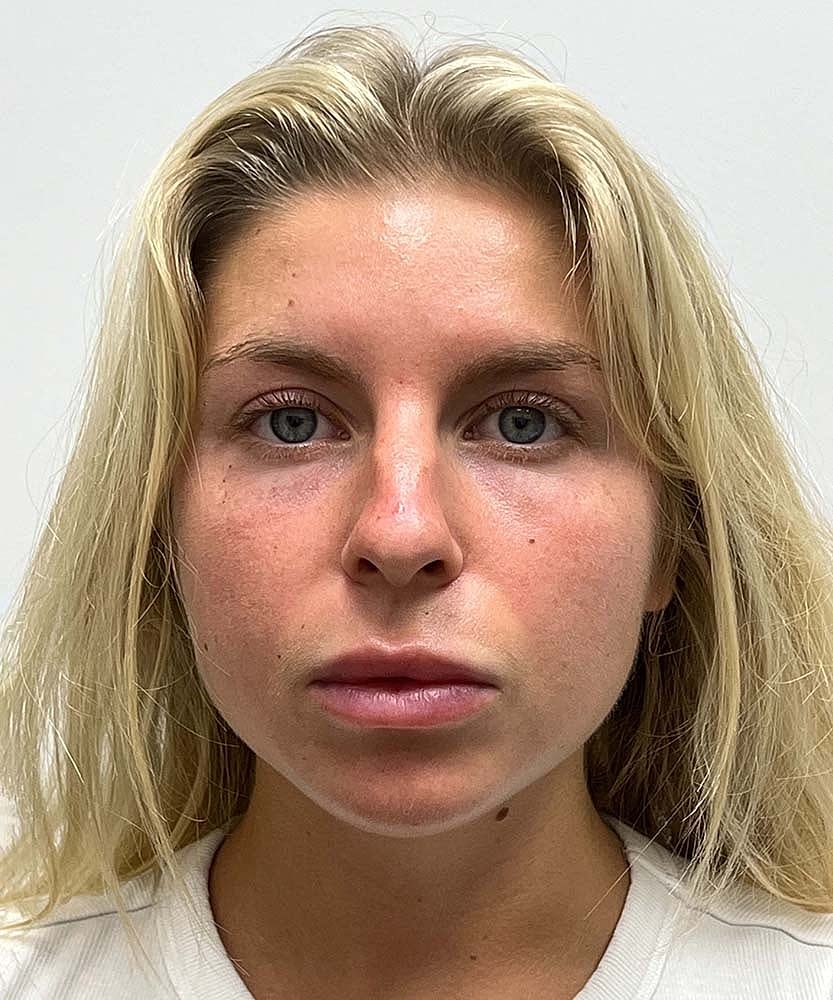 Rhinoplasty Before & After