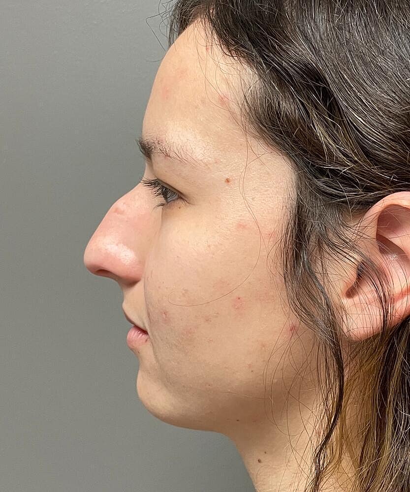 Rhinoplasty Before & After