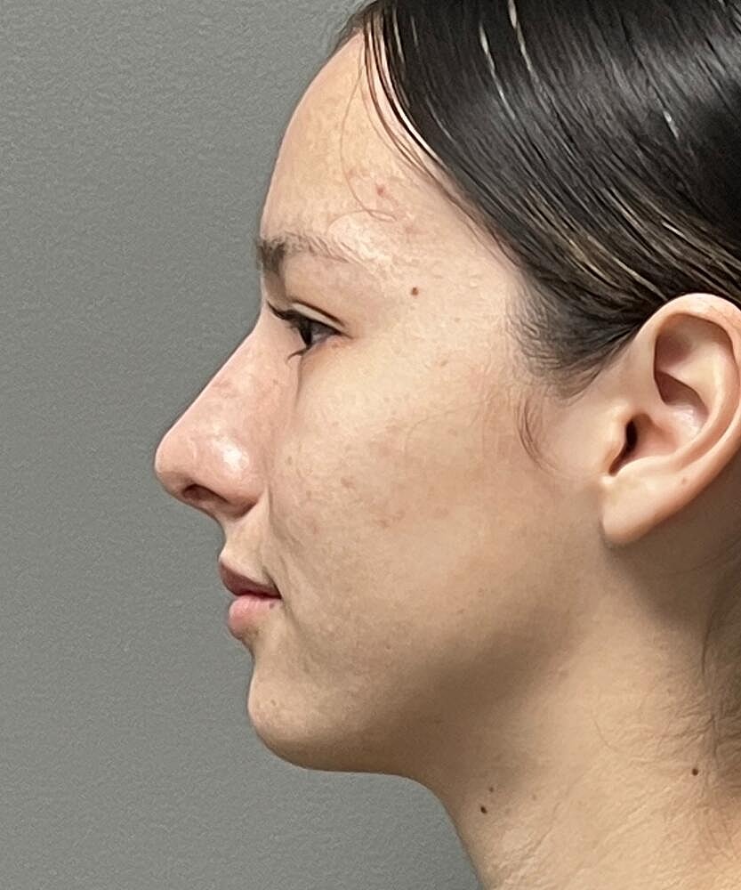 Rhinoplasty Before & After