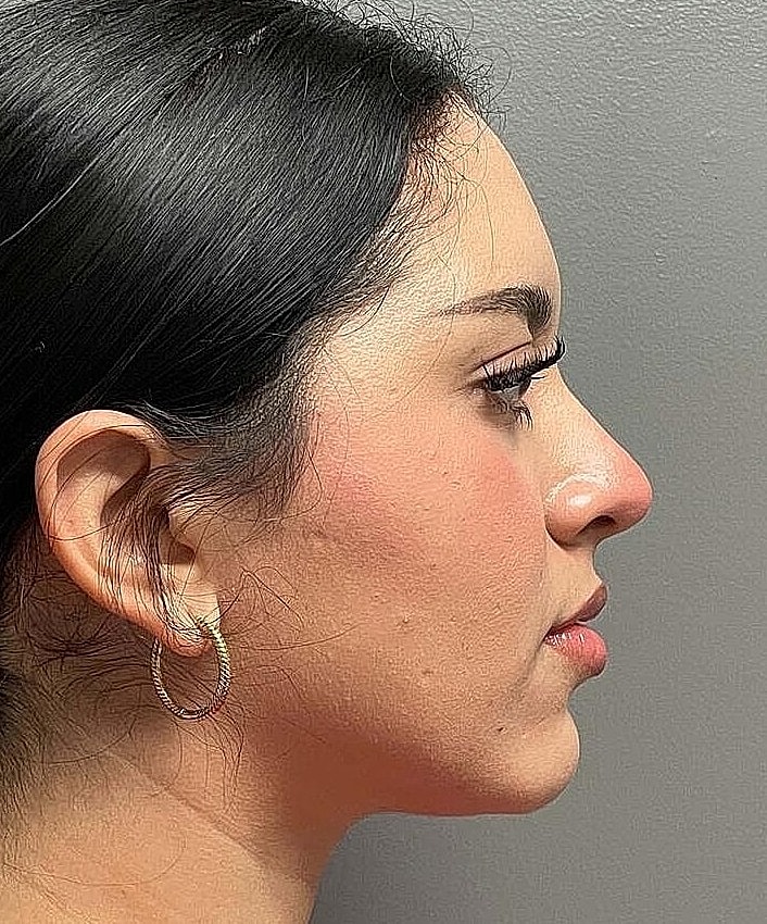 Rhinoplasty Before & After