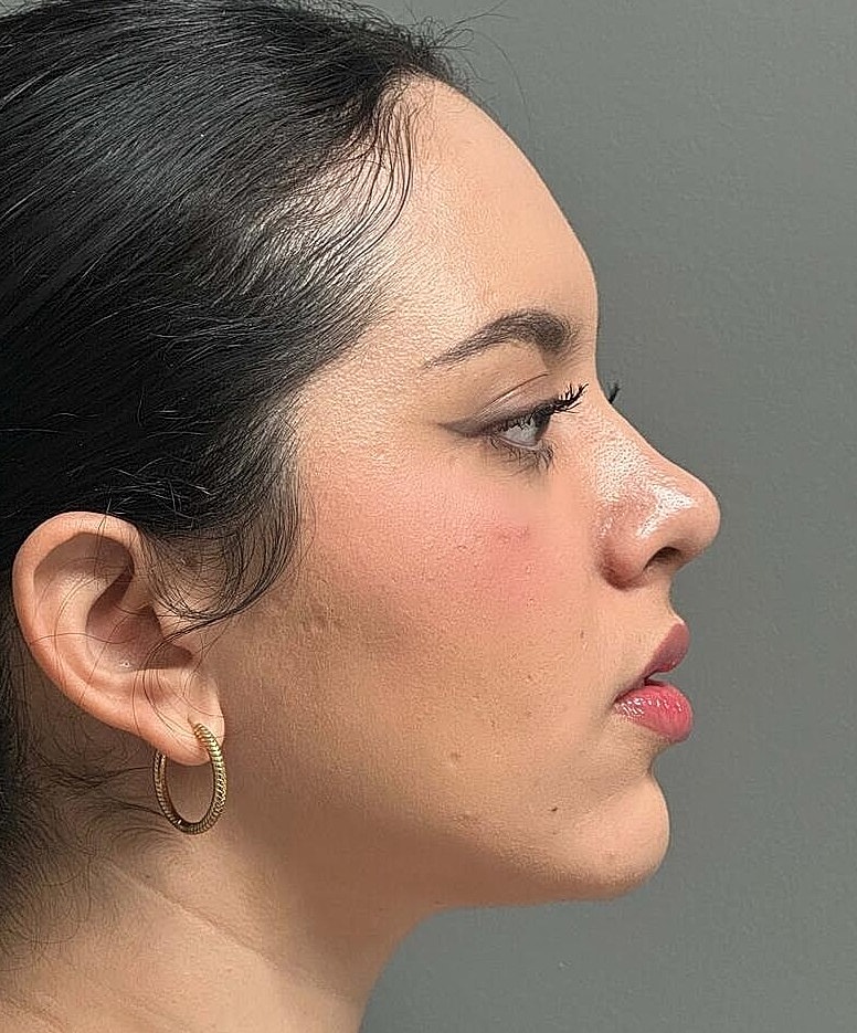 Rhinoplasty Before & After