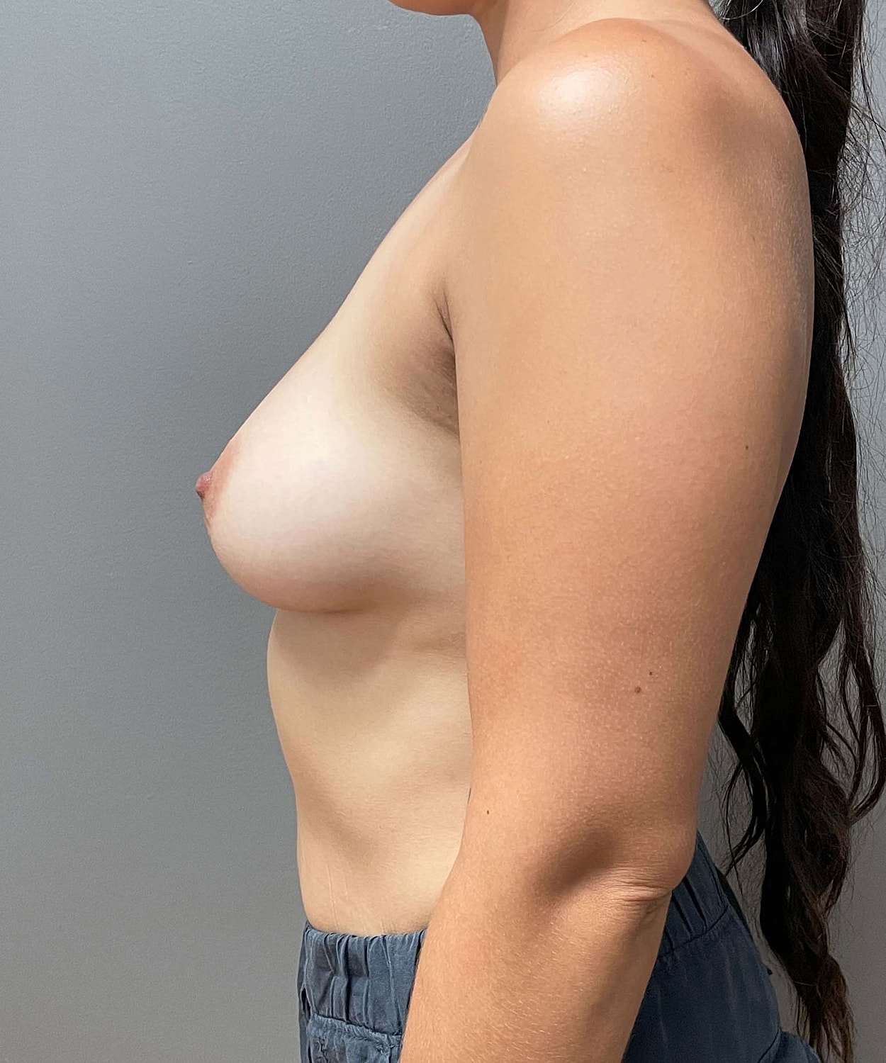 Breast Augmentation Gallery (Nude) Before & After