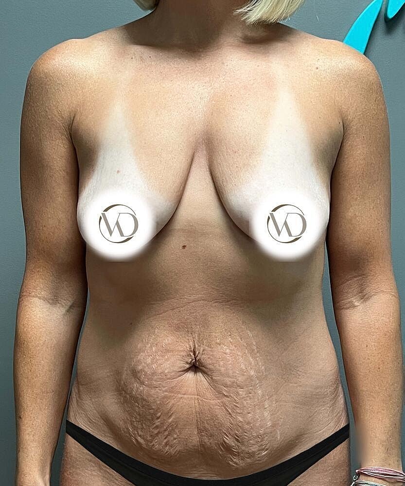 Breast Lift Implants Before & After