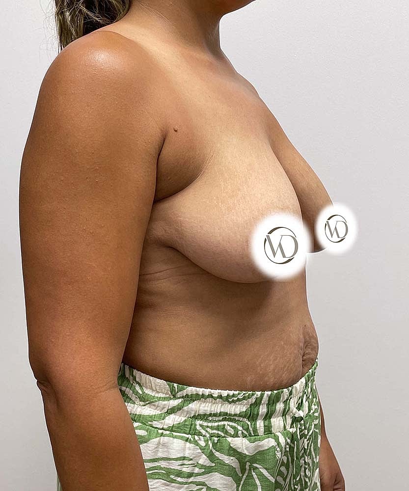 Breast Lift Implants Before & After